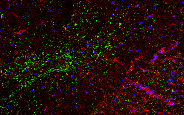 Characteristic staining of p-Tau (green) in a case of CTE.  Claudin-5 (red) protein levels are discontinuous and not present in areas of p-Tau accumulation around blood vessels. This is an indication of a dysfunctional blood brain barrier.
